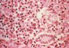 Les contamos sobre el Hantavirus