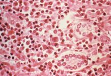 Les contamos sobre el Hantavirus