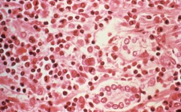 Les contamos sobre el Hantavirus